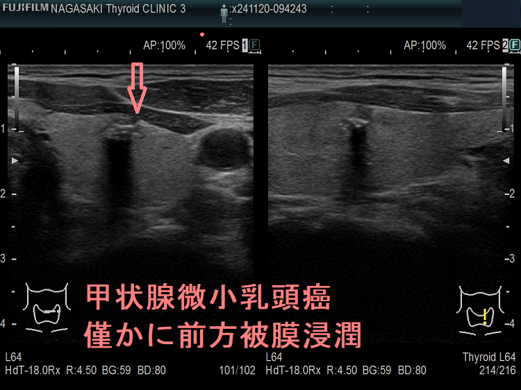 甲状腺微小乳頭癌 僅かに前方被膜浸潤 超音波(エコー)画像 甲状腺微小乳頭癌 僅かに前方被膜浸潤 超音波(エコー)画像