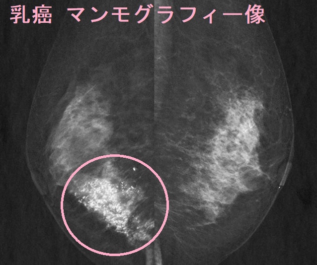 乳癌 マンモグラフィー像 乳癌 マンモグラフィー像