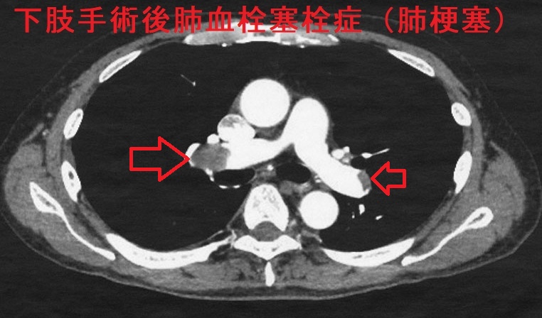 下肢手術後肺血栓塞栓症(肺梗塞) 下肢手術後肺血栓塞栓症(肺梗塞)