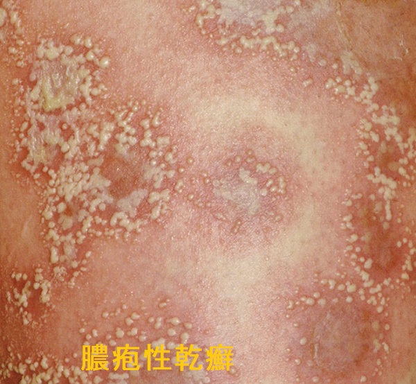 膿疱性乾癬 膿疱性乾癬