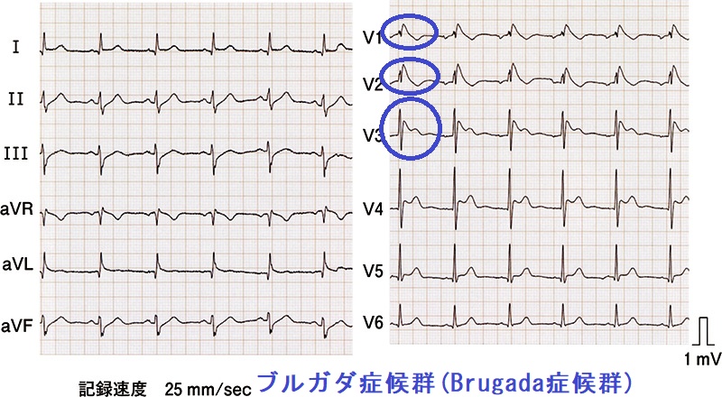 ブルガダ症候群(Brugada症候群)(ポックリ病) ブルガダ症候群(Brugada症候群)(ポックリ病)
