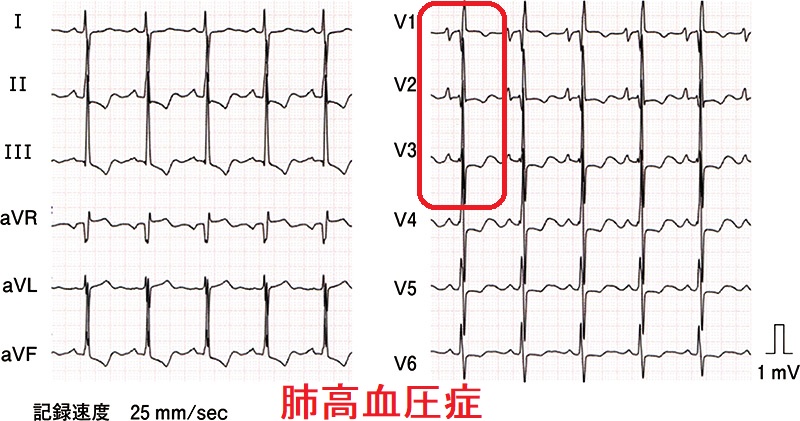 肺高血圧症の心電図 肺高血圧症の心電図