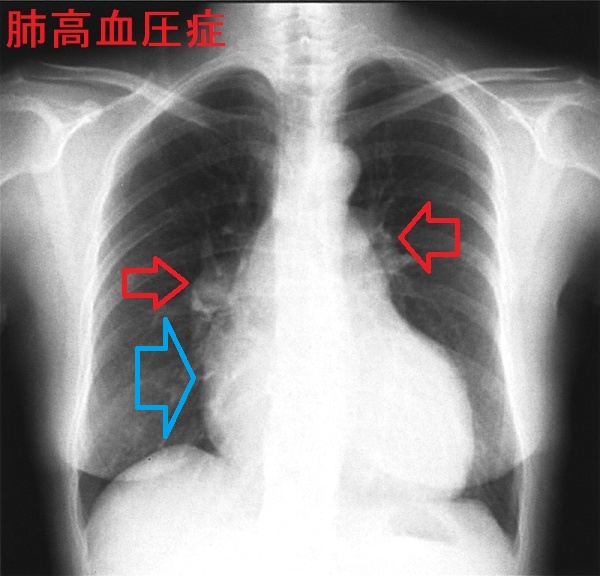 肺高血圧症の胸部エックス線写真 肺高血圧症の胸部エックス線写真