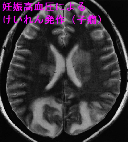 妊娠高血圧によるけいれん発作(子癇)頭部MRIのT2強調像 妊娠高血圧によるけいれん発作(子癇)頭部MRIのT2強調像