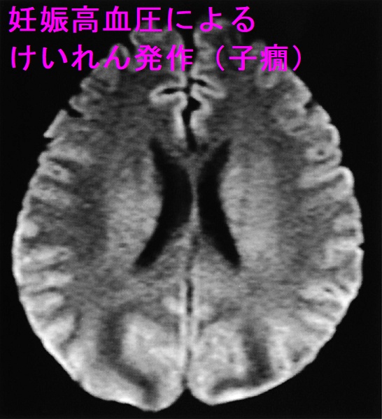 妊娠高血圧によるけいれん発作(子癇)拡散強調像 妊娠高血圧によるけいれん発作(子癇)拡散強調像