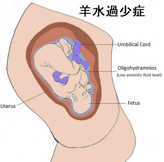 羊水過少症 羊水過少症