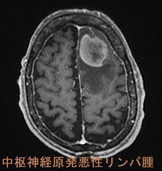 甲状腺以外の悪性リンパ腫(唾液腺MALT 血管内リンパ腫 頚部悪性 甲状腺以外の悪性リンパ腫(唾液腺MALT 血管内リンパ腫 頚部悪性