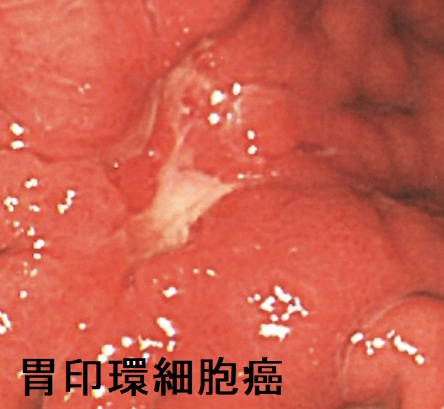 胃印環細胞癌 上部消化管内視鏡像 胃印環細胞癌 上部消化管内視鏡像