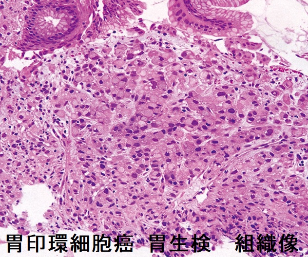 胃印環細胞癌 胃生検 組織像 胃印環細胞癌 胃生検 組織像
