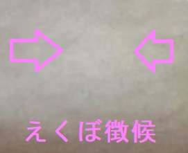 えくぼ徴候 えくぼ徴候