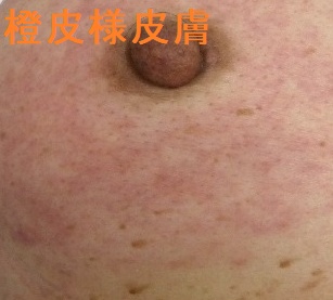橙皮様皮膚 橙皮様皮膚