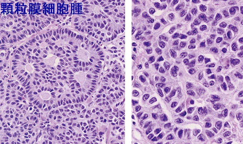 顆粒膜細胞腫 組織像 顆粒膜細胞腫 組織像