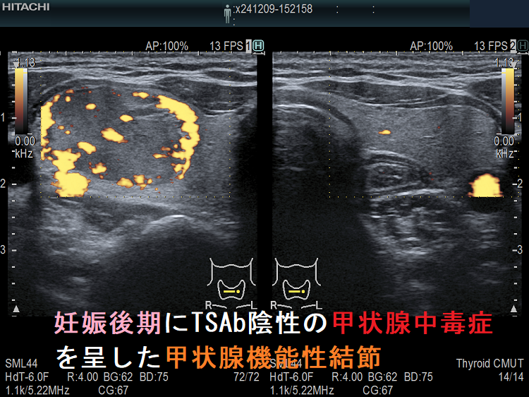 妊娠後期にTSAb陰性の甲状腺中毒症を呈した甲状腺機能性結節 妊娠後期にTSAb陰性の甲状腺中毒症を呈した甲状腺機能性結節