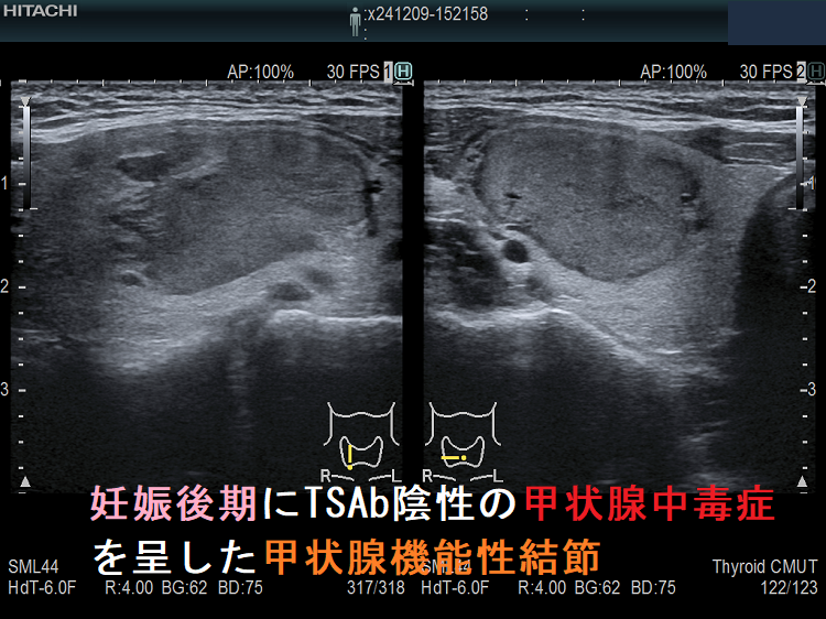 妊娠後期にTSAb陰性の甲状腺中毒症を呈した甲状腺機能性結節1 妊娠後期にTSAb陰性の甲状腺中毒症を呈した甲状腺機能性結節1