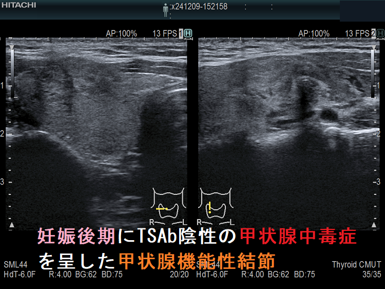 妊娠後期にTSAb陰性の甲状腺中毒症を呈した甲状腺機能性結節1 妊娠後期にTSAb陰性の甲状腺中毒症を呈した甲状腺機能性結節1