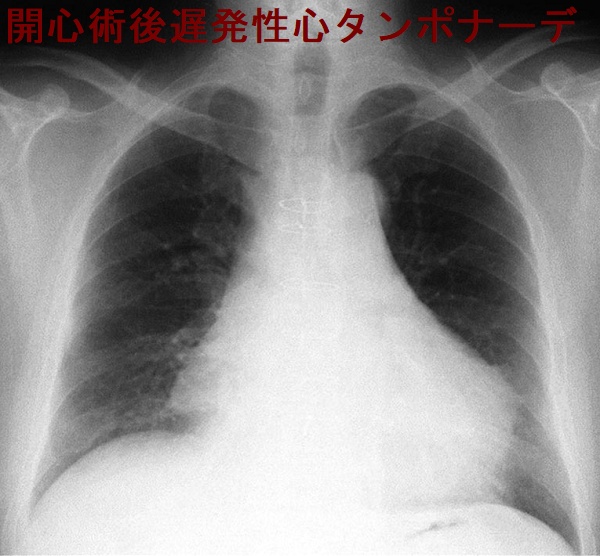 開心術後遅発性心タンポナーデ 胸部エックス線写真 開心術後遅発性心タンポナーデ 胸部エックス線写真