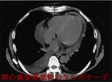 開心術後遅発性心タンポナーデ 単純CT写真 開心術後遅発性心タンポナーデ 単純CT写真