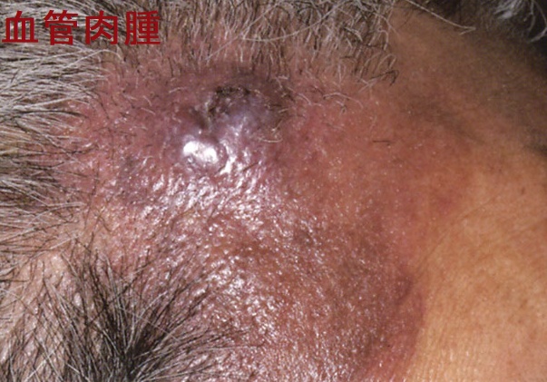 甲状腺と皮膚の異常③悪性腫瘍編[橋本病 バセドウ病 甲状腺