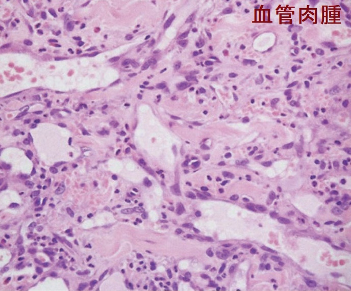 血管肉腫 病理組織H-E 染色標本 血管肉腫 病理組織H-E 染色標本
