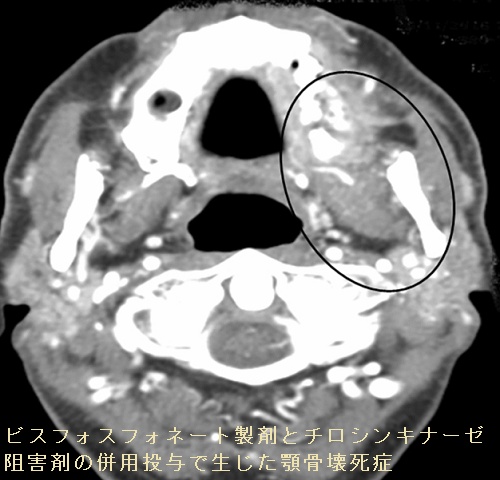甲状腺分化癌(乳頭癌・濾胞癌)骨転移の治療[橋本病 バセドウ病 甲状腺分化癌(乳頭癌・濾胞癌)骨転移の治療[橋本病 バセドウ病