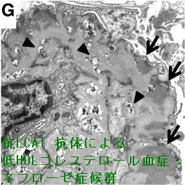 抗LCAT 抗体による低HDLコレステロール血症・ネフローゼ症候群 腎生検 電子顕微鏡所見 抗LCAT 抗体による低HDLコレステロール血症・ネフローゼ症候群 腎生検 電子顕微鏡所見