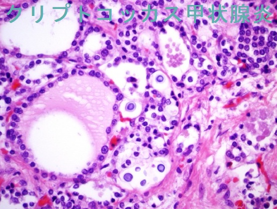 クリプトコッカス甲状腺炎 クリプトコッカス甲状腺炎