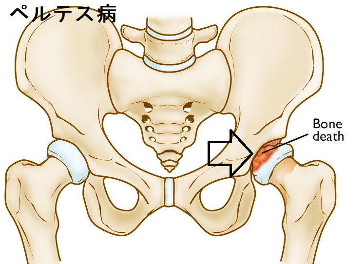 ペルテス病 ペルテス病