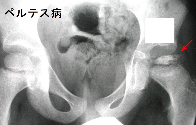 ペルテス病 単純エックス線写真 ペルテス病 単純エックス線写真
