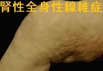 腎性全身性線維症 腎性全身性線維症