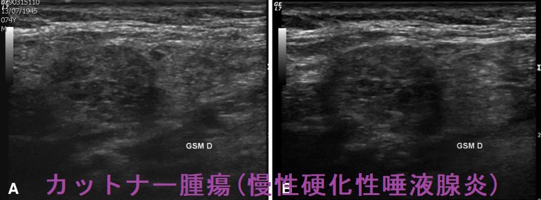 カットナー腫瘍(慢性硬化性唾液腺炎) 超音波(エコー)画像 カットナー腫瘍(慢性硬化性唾液腺炎) 超音波(エコー)画像