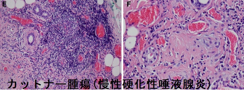 カットナー腫瘍(慢性硬化性唾液腺炎) 組織像 カットナー腫瘍(慢性硬化性唾液腺炎) 組織像