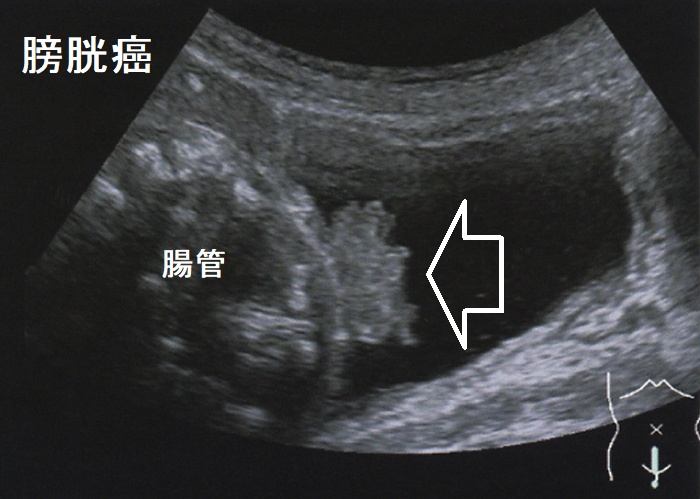 膀胱癌 超音波エコー写真 膀胱癌 超音波エコー写真