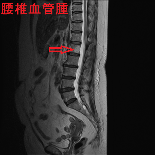 腰椎血管腫 MRI T2W1 腰椎血管腫 MRI T2W1