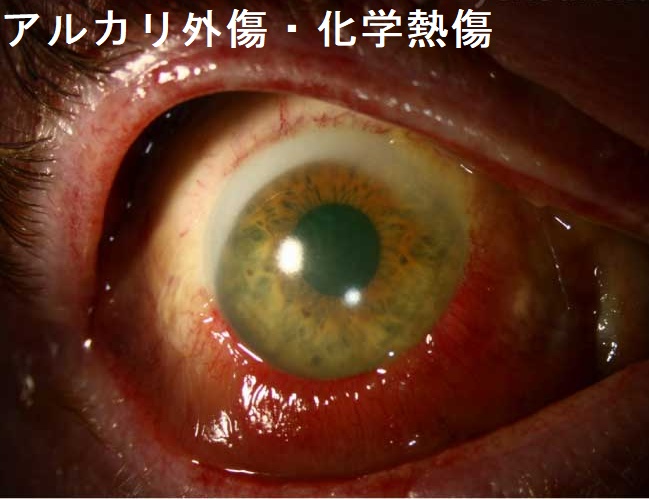 アルカリ外傷・化学熱傷 アルカリ外傷・化学熱傷