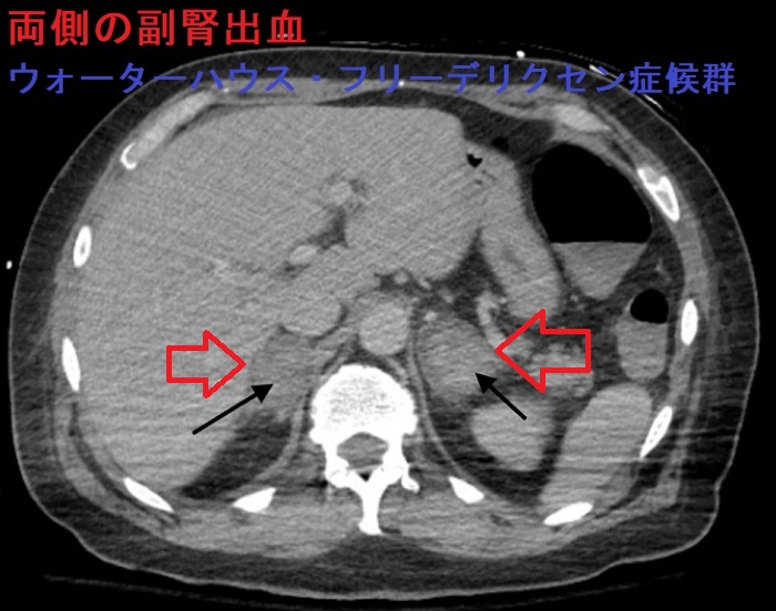 両側の副腎出血 ウォーターハウス・フリーデリクセン症候群 造影CT画像 両側の副腎出血 ウォーターハウス・フリーデリクセン症候群 造影CT画像