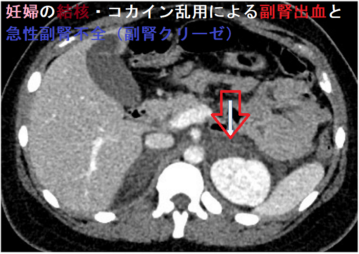 妊婦の結核・コカイン乱用による副腎出血と急性副腎不全(副腎クリーゼ) 妊婦の結核・コカイン乱用による副腎出血と急性副腎不全(副腎クリーゼ)