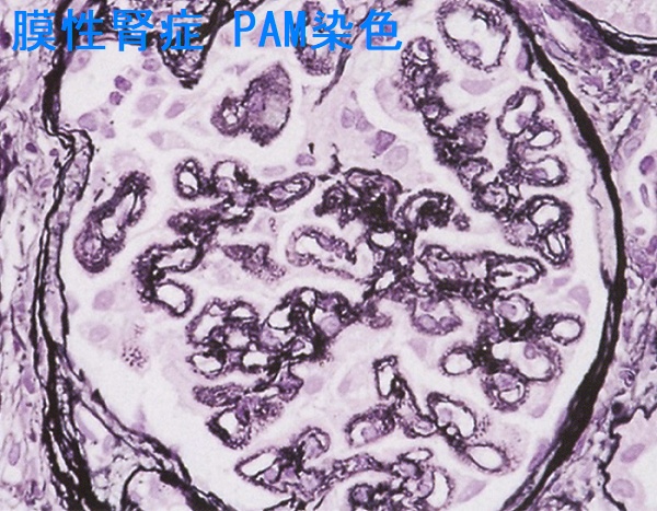 膜性腎症(MN)腎生検(PAM 染色) 膜性腎症(MN)腎生検(PAM 染色)