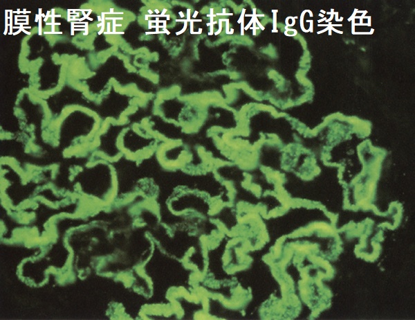 膜性腎症 蛍光抗体IgG染色標本 膜性腎症 蛍光抗体IgG染色標本