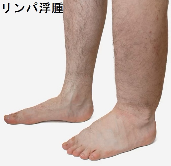 リンパ浮腫 リンパ浮腫