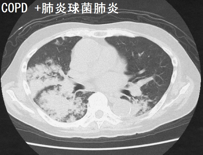 COPD +肺炎球菌肺炎 CT画像 COPD +肺炎球菌肺炎 CT画像