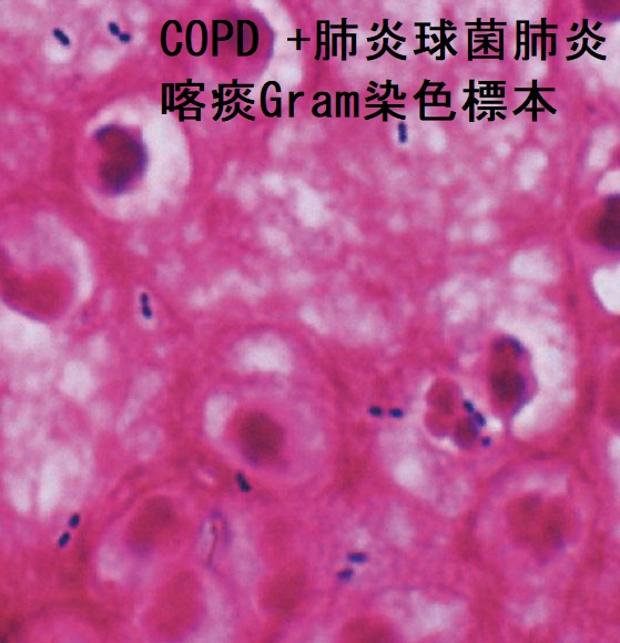 COPD +肺炎球菌肺炎 喀痰Gram染色標本 COPD +肺炎球菌肺炎 喀痰Gram染色標本
