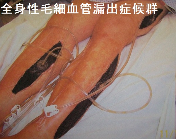 急性コンパートメント症候群を合併した全身性毛細血管漏出症候群 急性コンパートメント症候群を合併した全身性毛細血管漏出症候群