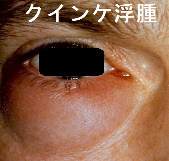 クインケ浮腫 クインケ浮腫