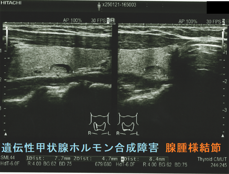 遺伝性甲状腺ホルモン合成障害 腺腫様結節 遺伝性甲状腺ホルモン合成障害 腺腫様結節