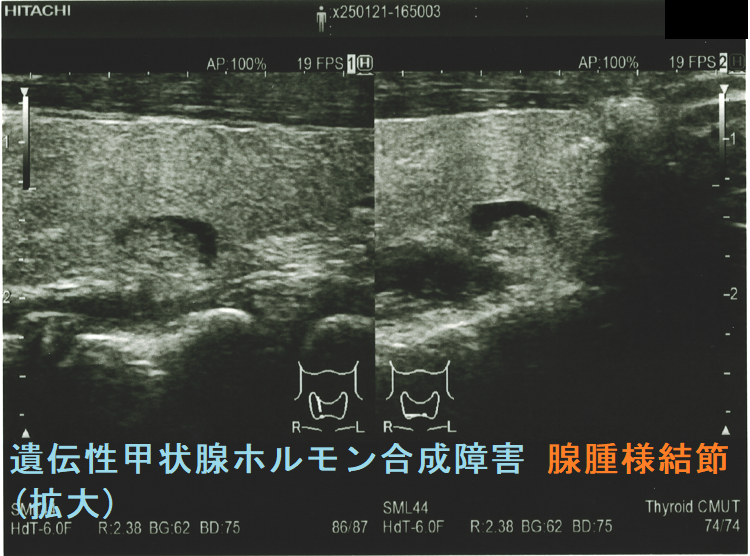 遺伝性甲状腺ホルモン合成障害 腺腫様結節(拡大) 遺伝性甲状腺ホルモン合成障害 腺腫様結節(拡大)