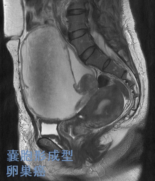 嚢胞形成型卵巣癌 骨盤部単純MRI T2 強調矢状断像 嚢胞形成型卵巣癌 骨盤部単純MRI T2 強調矢状断像