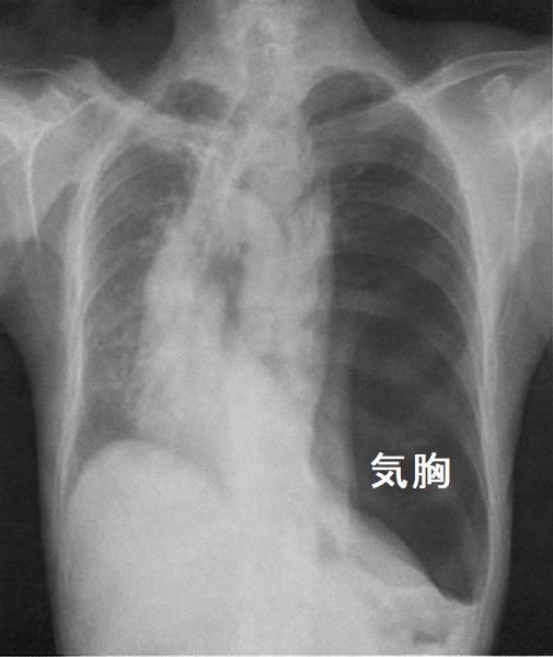 再膨張性肺水腫 胸腔ドレーン挿入前 再膨張性肺水腫 胸腔ドレーン挿入前