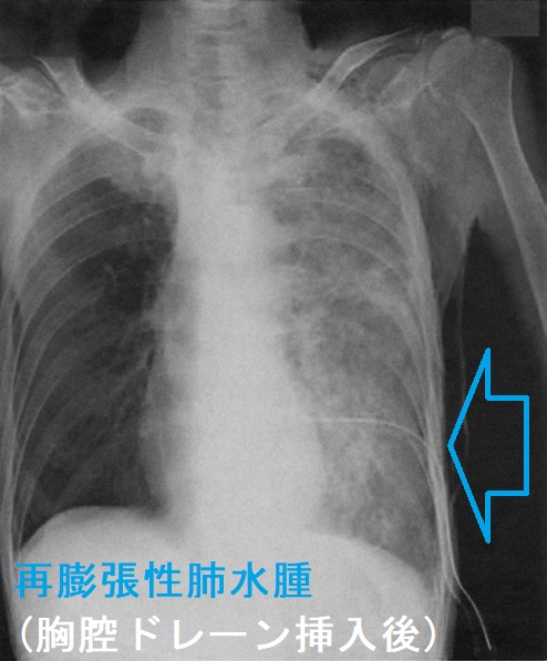 再膨張性肺水腫 胸腔ドレーン挿入後 再膨張性肺水腫 胸腔ドレーン挿入後