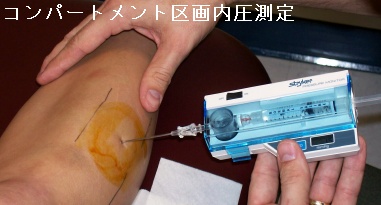 コンパートメント区画内圧測定 コンパートメント区画内圧測定