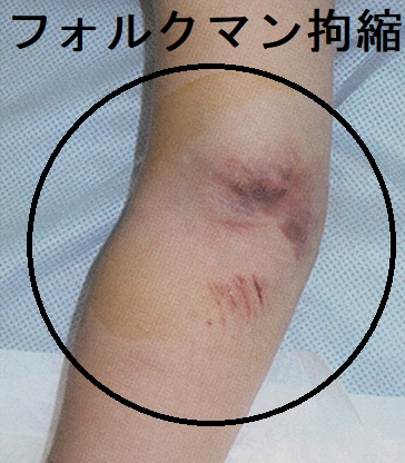 フォルクマン拘縮 フォルクマン拘縮